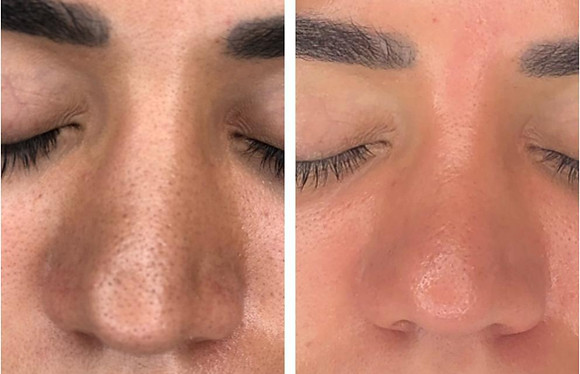 Vorher Nachher Hydrafacial Wien – sichtbar reinere Haut, verfeinerte Poren und strahlender Teint