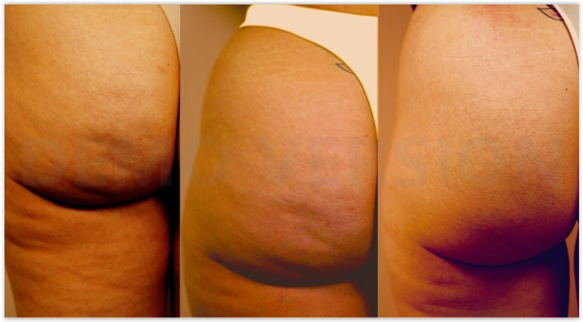 creme cleopatra contre les vergetures la cellulite les inflamations