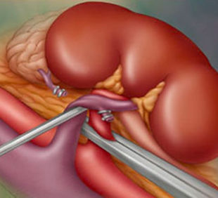 trasplante-renal1.jpg