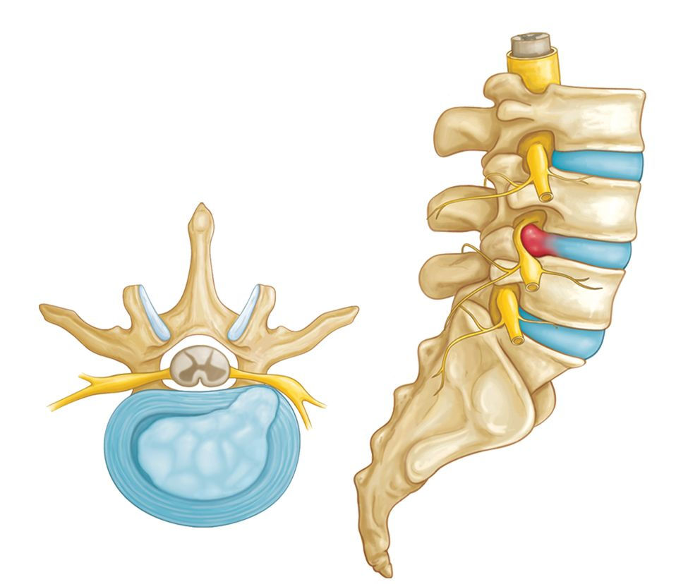 model of the spine, disc, and nerve