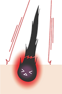 毛イラスト-セルフ脱毛ミルフィーユ