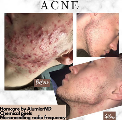Professional acne facial treatment Glasgow