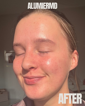 Acne treatment results at HWFGlow Glasgow West End
