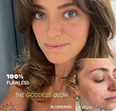 Acne treatment results at HWFGlow Glasgow West End