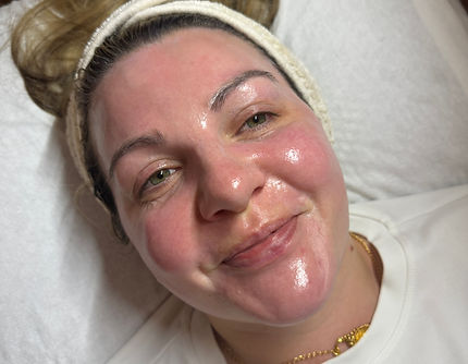Chemical peel treatment at HWFGlow Glasgow