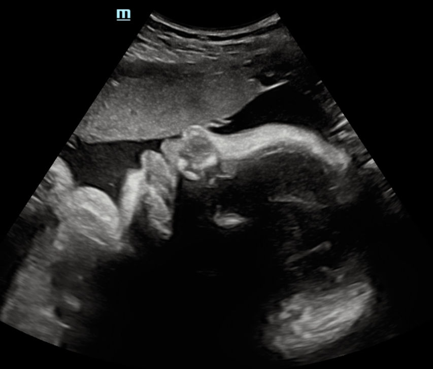 Peek a Boo Baby 3D 4D Ultrasound