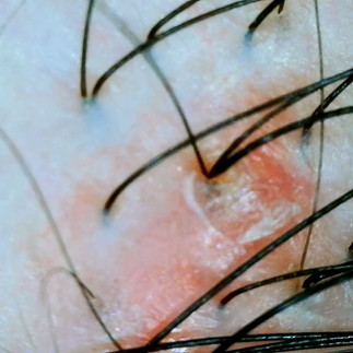 blister on hair follicle