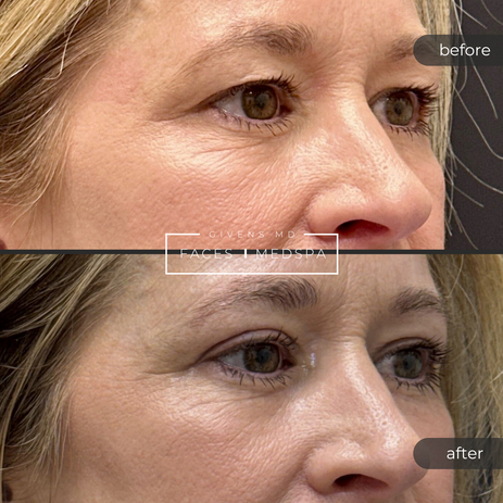 Upper Eyelid Surgery Before and After