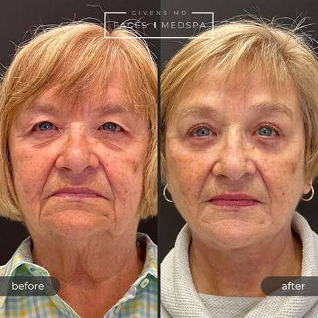 Best facelift, neck lift, and blepharoplasty before and after