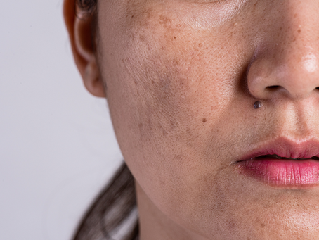 MELASMA: causas, sintomas e tratamentos mais eficazes