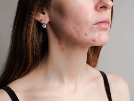 Mulher adulta com espinhas em áreas típicas da acne adulta