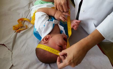 Vírus bovino é encontrado em tecidos de bebês com microcefalia