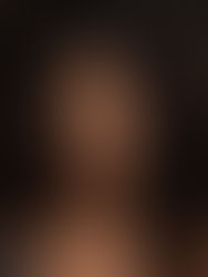 How to Choose the Right Hair Transplant Clinic: 6 Things to Look For