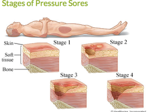 Bed and/or Chair Rest + Neglect = Bedsores