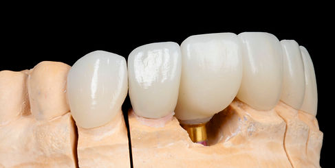 CORONAS MONOLITICAS SOBRE DIENTES Y IMPLANTE .jpg