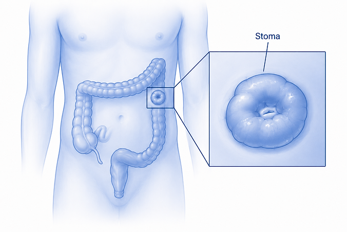 colostomy.png
