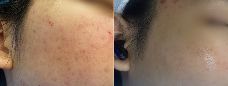 Điều trị sẹo rỗ tại TP.HCM: Hiểu đúng làn da, chọn hướng cải thiện 20