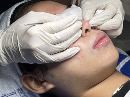 Điều trị mụn tại TP.HCM – Thăm khám tại Nano Medical