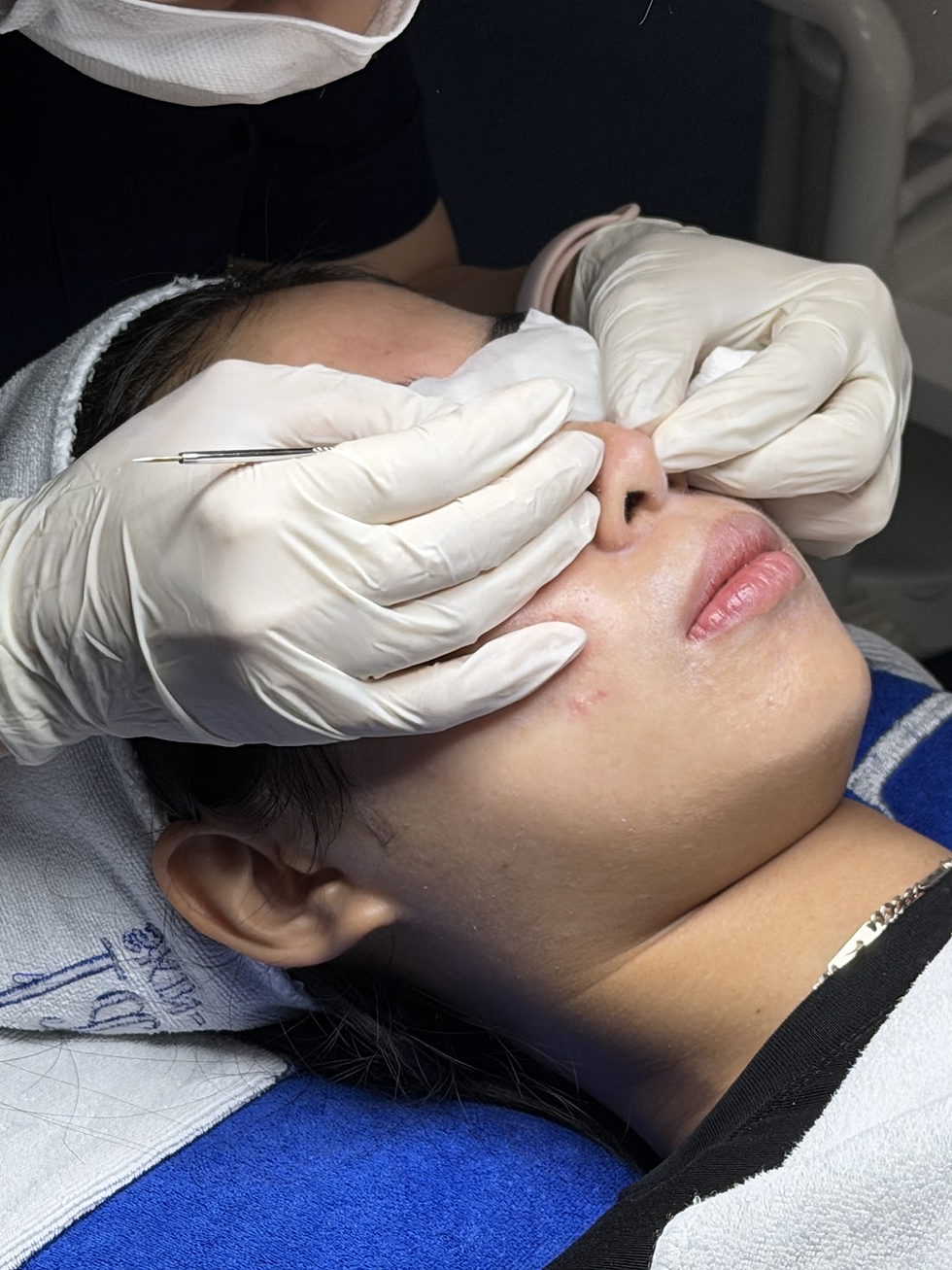 Điều trị mụn tại TP.HCM – Thăm khám tại Nano Medical