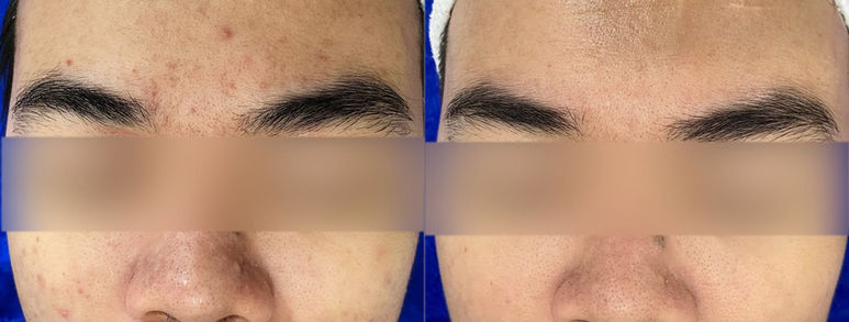 Điều trị sẹo rỗ tại TP.HCM: Hiểu đúng làn da, chọn hướng cải thiện 16