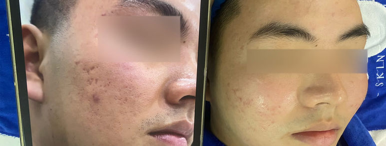 Điều trị sẹo rỗ tại TP.HCM: Hiểu đúng làn da, chọn hướng cải thiện 13