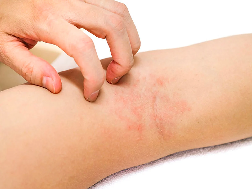 Phục hồi viêm da cơ địa nên bắt đầu từ đâu? Nano Medical