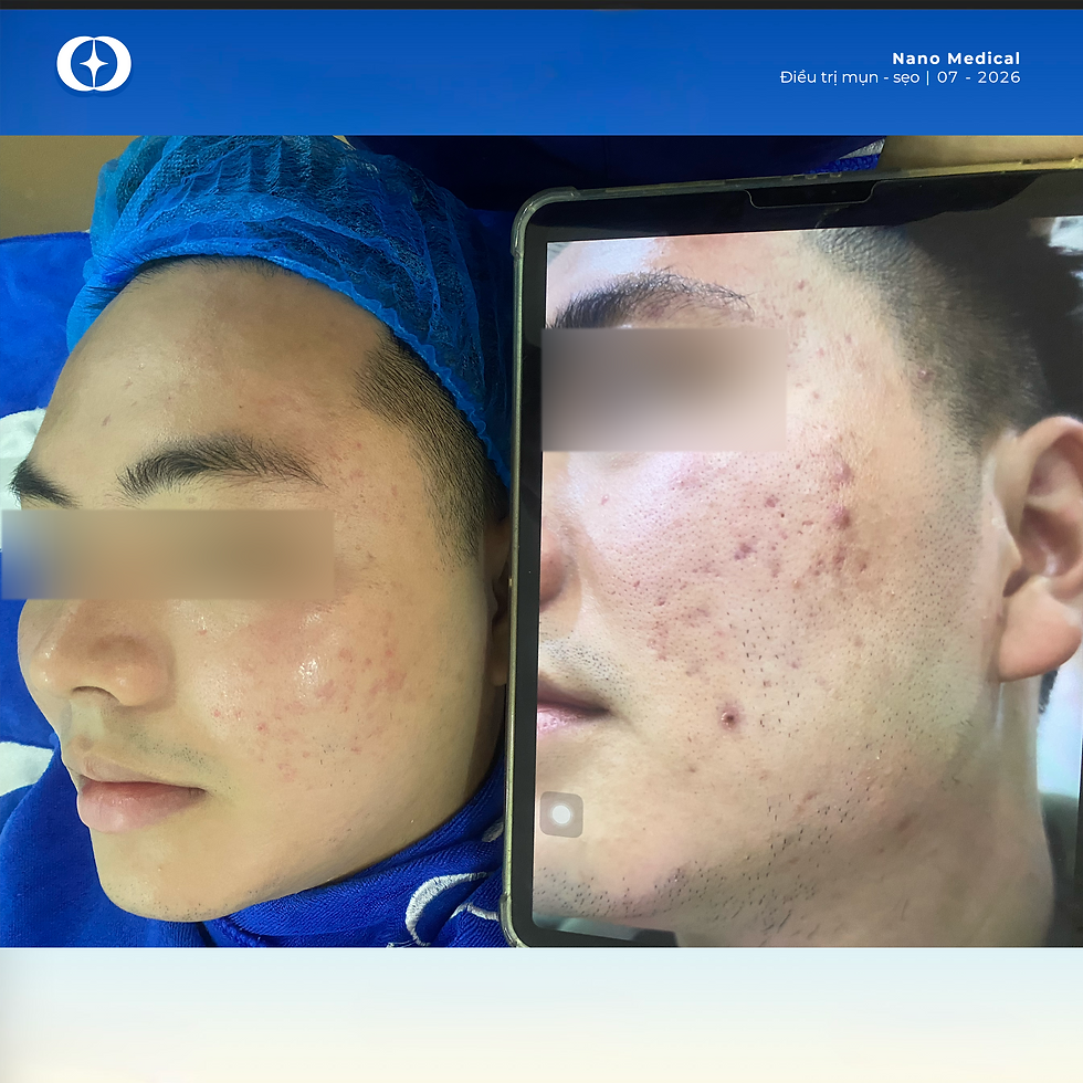 Kết quả bệnh nhân đến điều trị mụn sẹo tại bác sĩ Lã Hà
