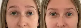 Botox_Before-After_Nano medical.webp