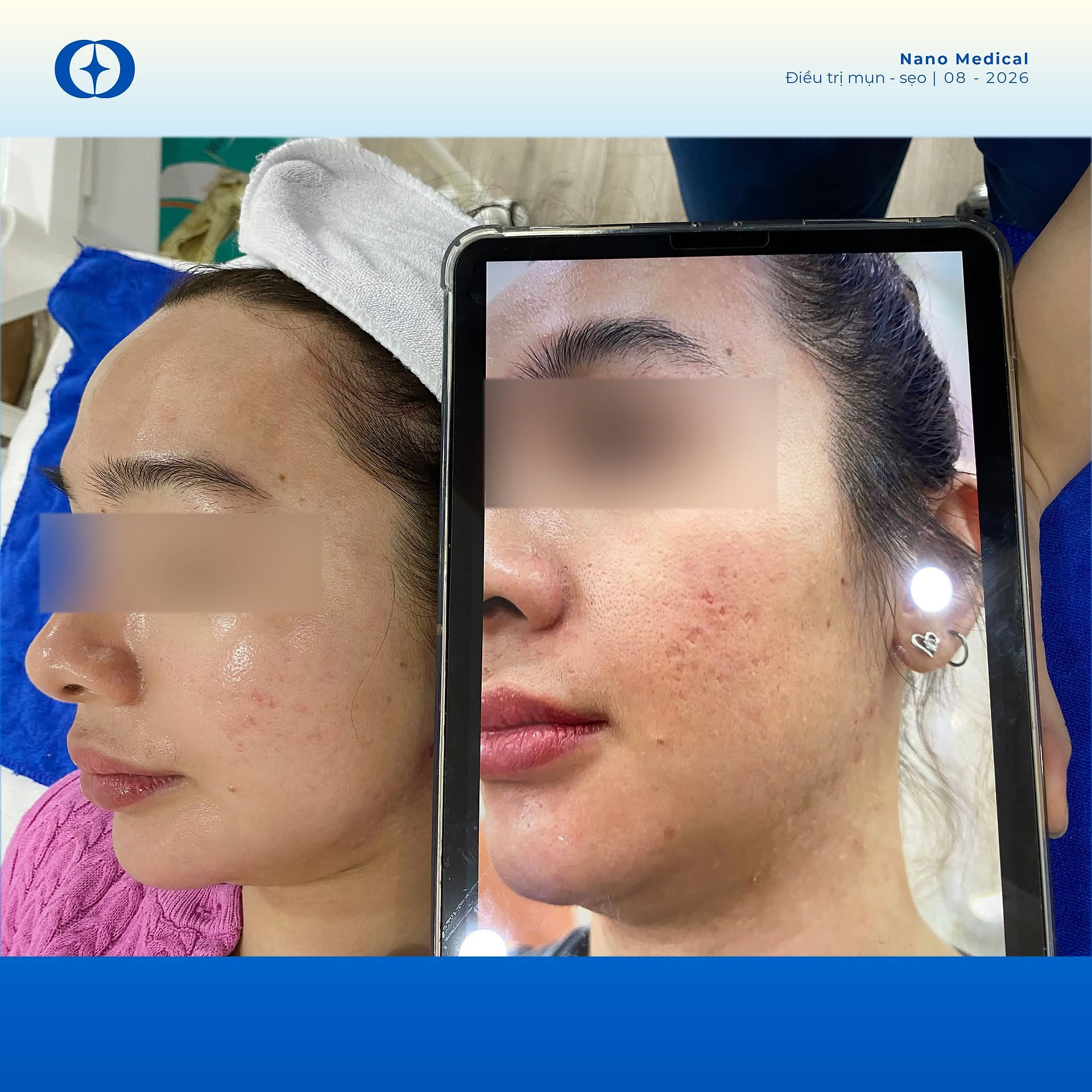 Điều trị sẹo rỗ tại Sài Gòn, Tp HCM 1
