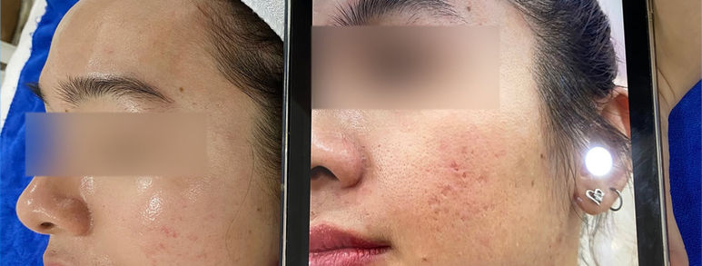 Điều trị sẹo rỗ tại TP.HCM: Hiểu đúng làn da, chọn hướng cải thiện 2