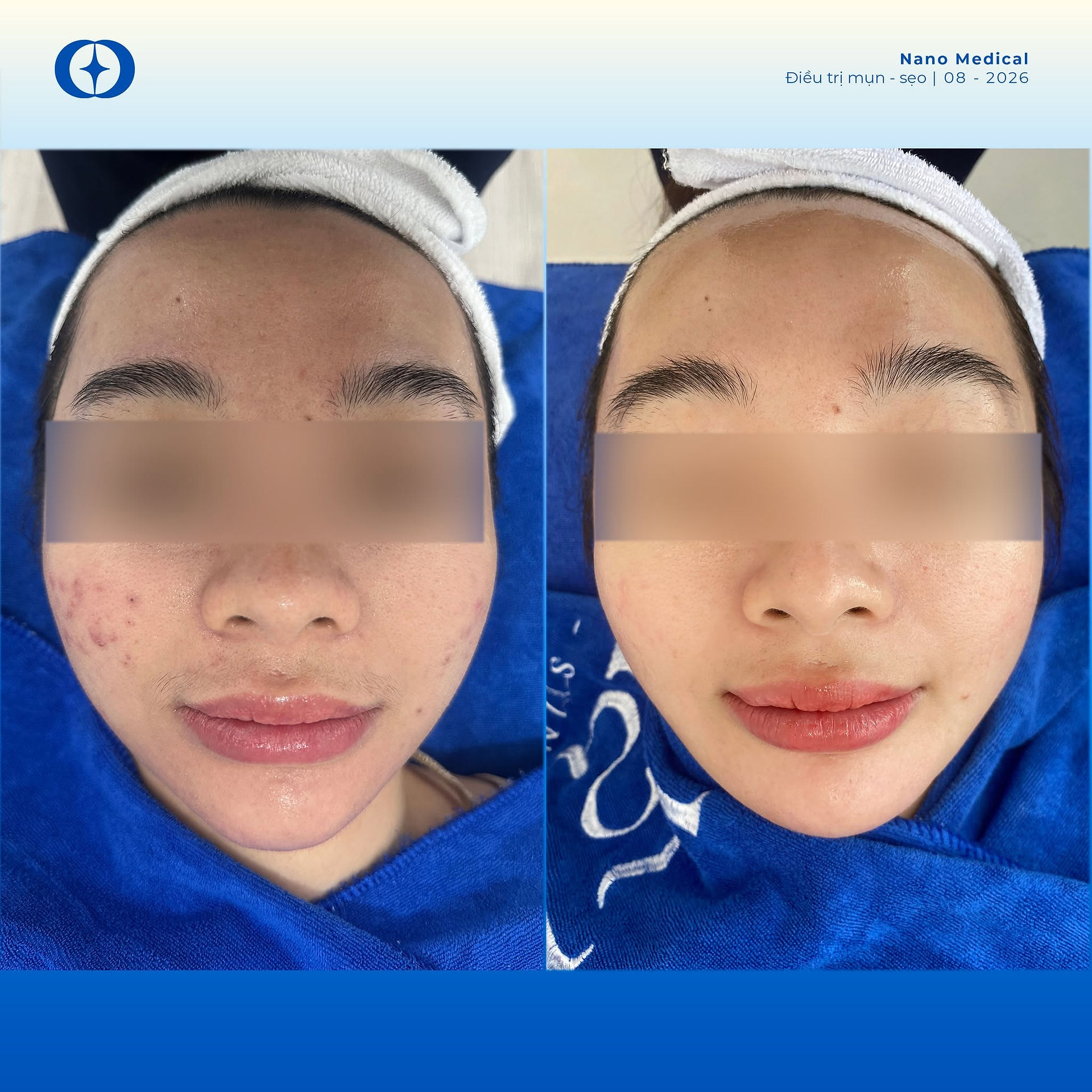 Điều trị sẹo rỗ tại Sài Gòn, Tp HCM 2