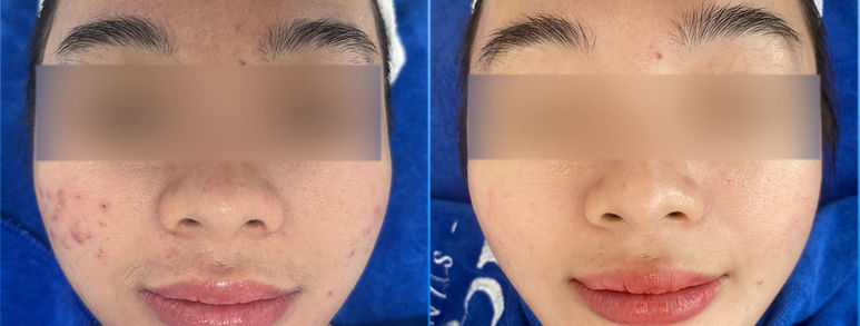 Điều trị sẹo rỗ tại TP.HCM: Hiểu đúng làn da, chọn hướng cải thiện 3