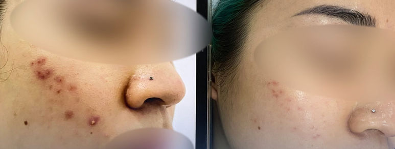Điều trị sẹo rỗ tại TP.HCM: Hiểu đúng làn da, chọn hướng cải thiện 24