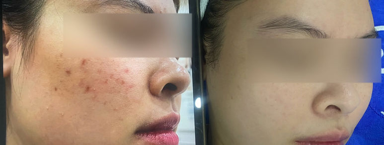 Điều trị sẹo rỗ tại TP.HCM: Hiểu đúng làn da, chọn hướng cải thiện 4