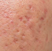sẹo mụn nano medical.png