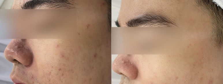 Điều trị sẹo rỗ tại TP.HCM: Hiểu đúng làn da, chọn hướng cải thiện 18