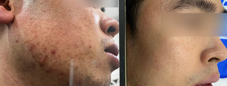 Điều trị sẹo rỗ tại TP.HCM: Hiểu đúng làn da, chọn hướng cải thiện 17