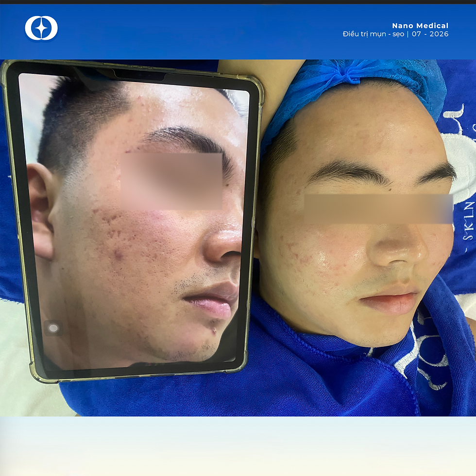 Bệnh nhân tái khám điều trị mun sẹo