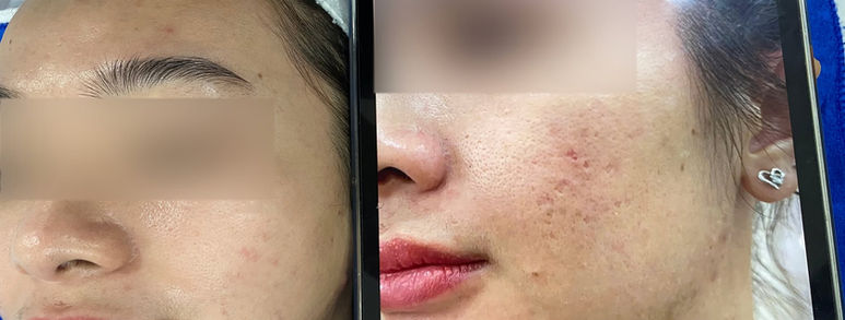 Điều trị sẹo rỗ tại TP.HCM: Hiểu đúng làn da, chọn hướng cải thiện 5