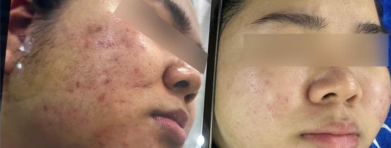 Điều trị sẹo rỗ tại TP.HCM: Hiểu đúng làn da, chọn hướng cải thiện 12