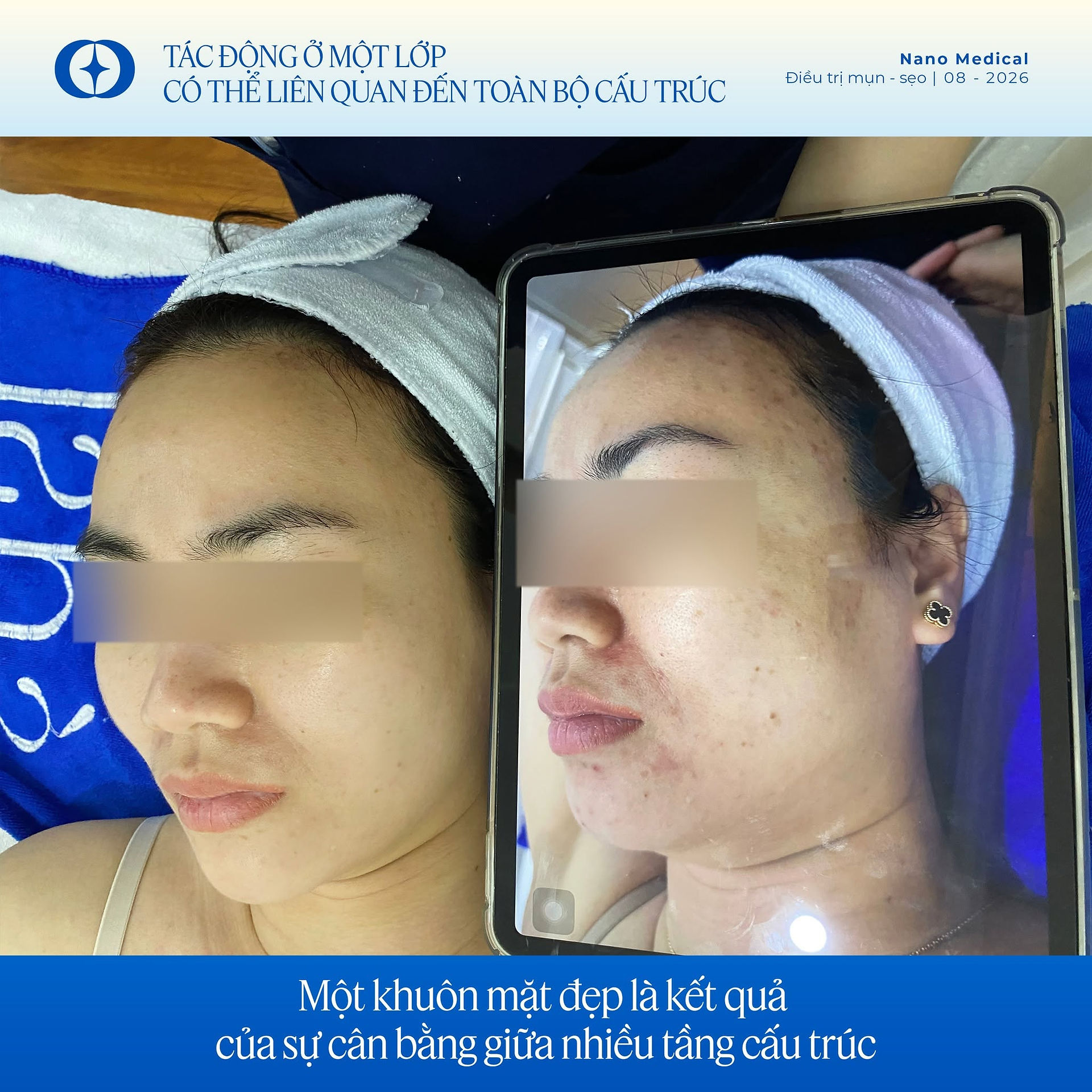 Điều trị sẹo rỗ tại Sài Gòn, Tp HCM