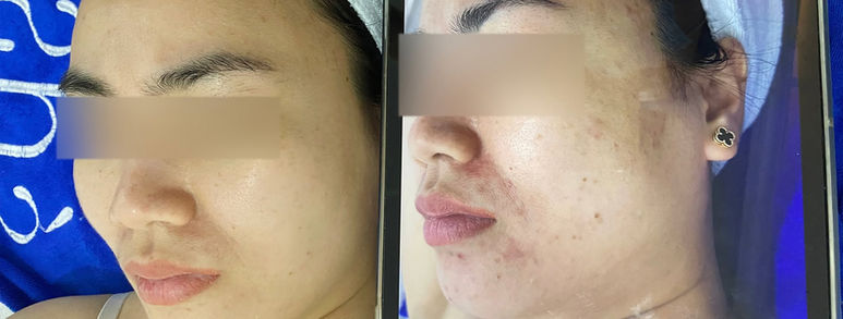 Điều trị sẹo rỗ tại TP.HCM: Hiểu đúng làn da, chọn hướng cải thiện 1