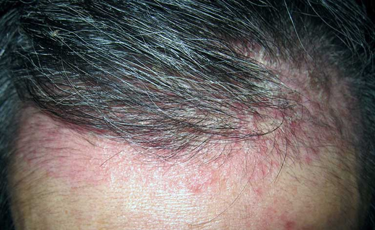 Viêm da cơ địa là gì? Nano Medical