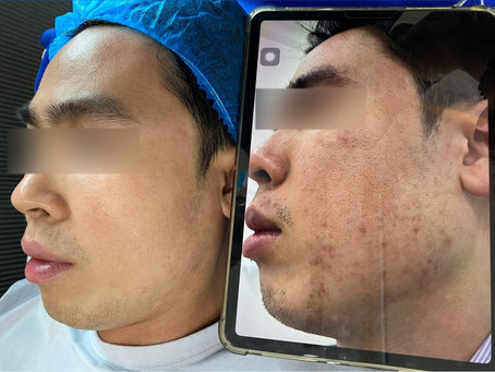 Điều trị sẹo rỗ tại TP.HCM: Hiểu đúng làn da, chọn hướng cải thiện