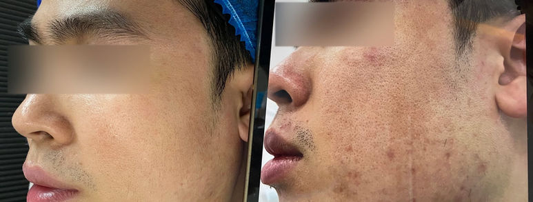 Điều trị sẹo rỗ tại TP.HCM: Hiểu đúng làn da, chọn hướng cải thiện 15