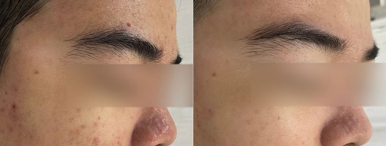 Điều trị sẹo rỗ tại TP.HCM: Hiểu đúng làn da, chọn hướng cải thiện 19
