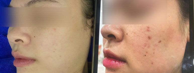 Điều trị sẹo rỗ tại TP.HCM: Hiểu đúng làn da, chọn hướng cải thiện 6