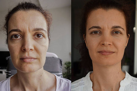 Before and After Graves Disease.jpg