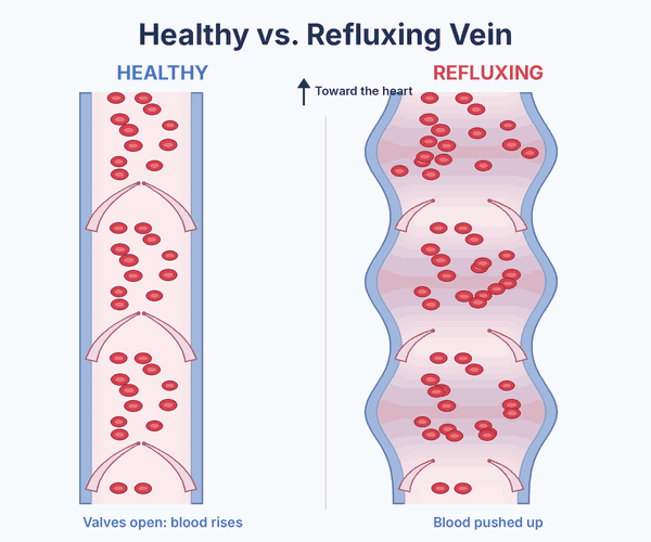 healthy-vs-refluxing-vein-side-by-side-animation_600w-email.gif