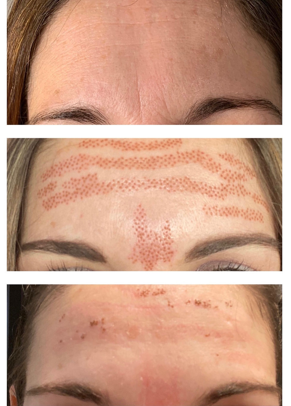 Fibroblast Skin Tightening at Velo Med Spa: A Non-Surgical Way to Lift and Tighten Skin